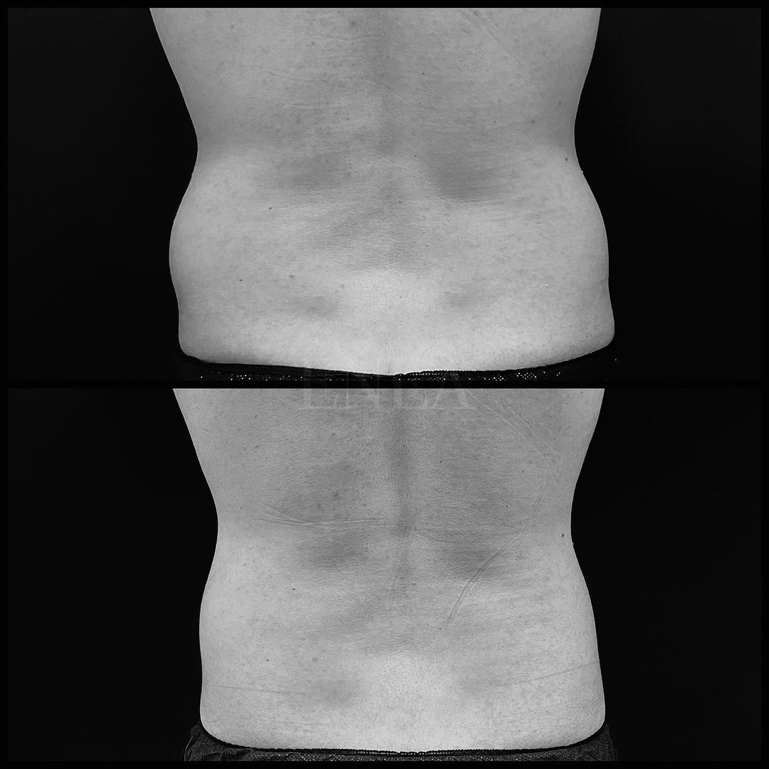 Liposucción sin cirugía, CoolSculpting