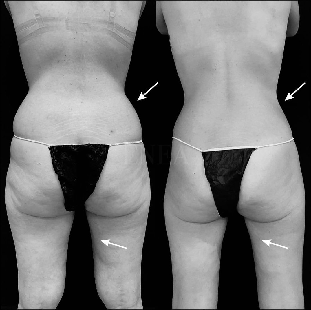 Liposucción sin cirugía, CoolSculpting