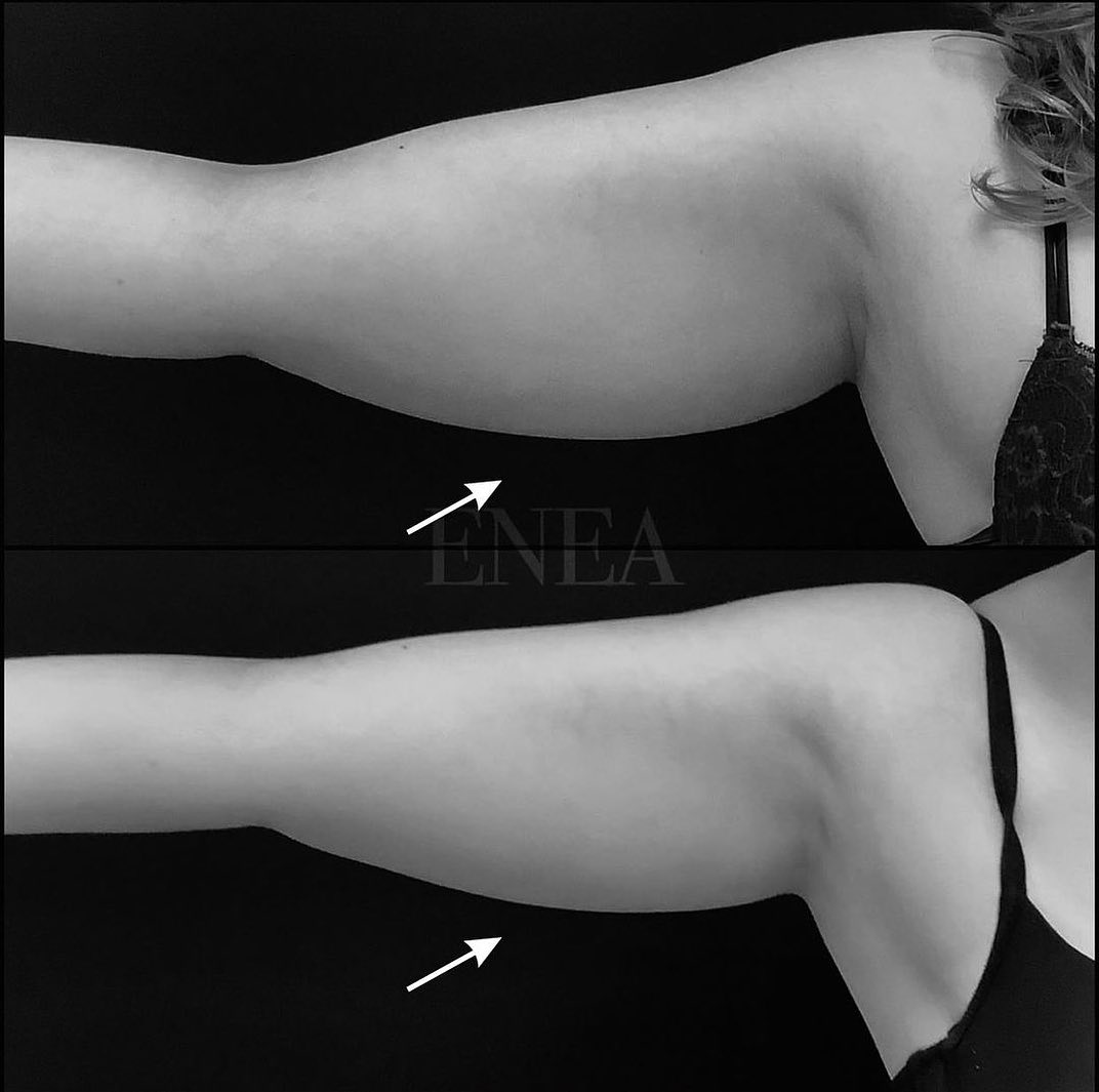 Liposucción sin cirugía, CoolSculpting