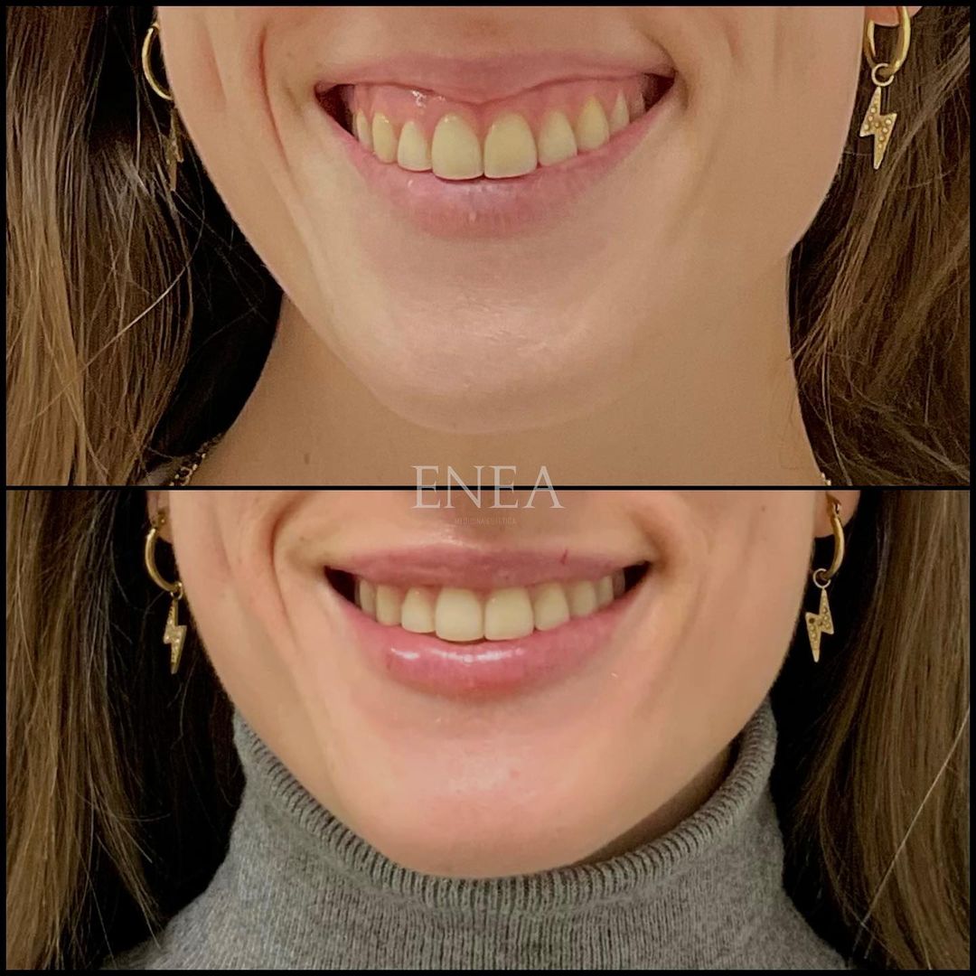 Sonrisa gingival