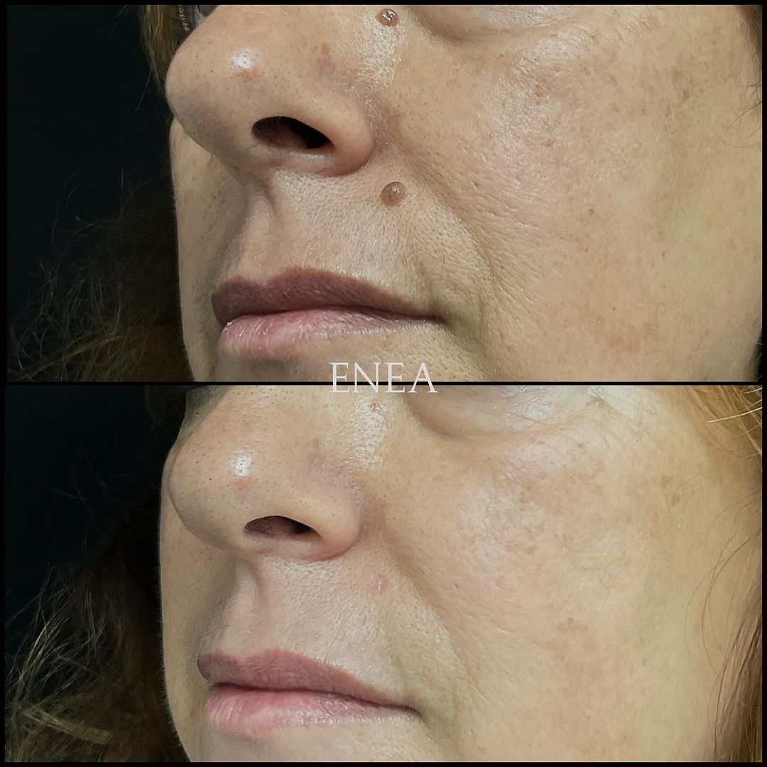 Eliminación de nevus