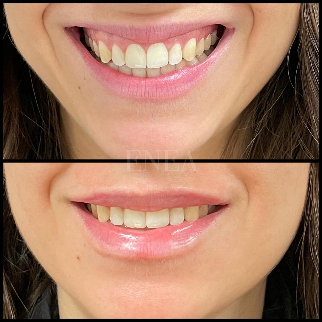 Aumento de labio y corrección de sonrisa gingival