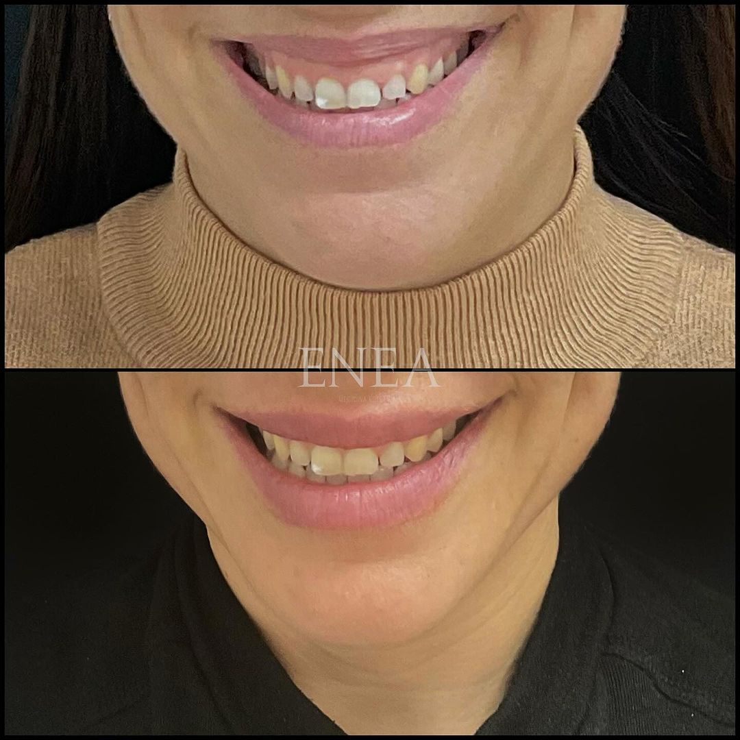 Sonrisa Gingival