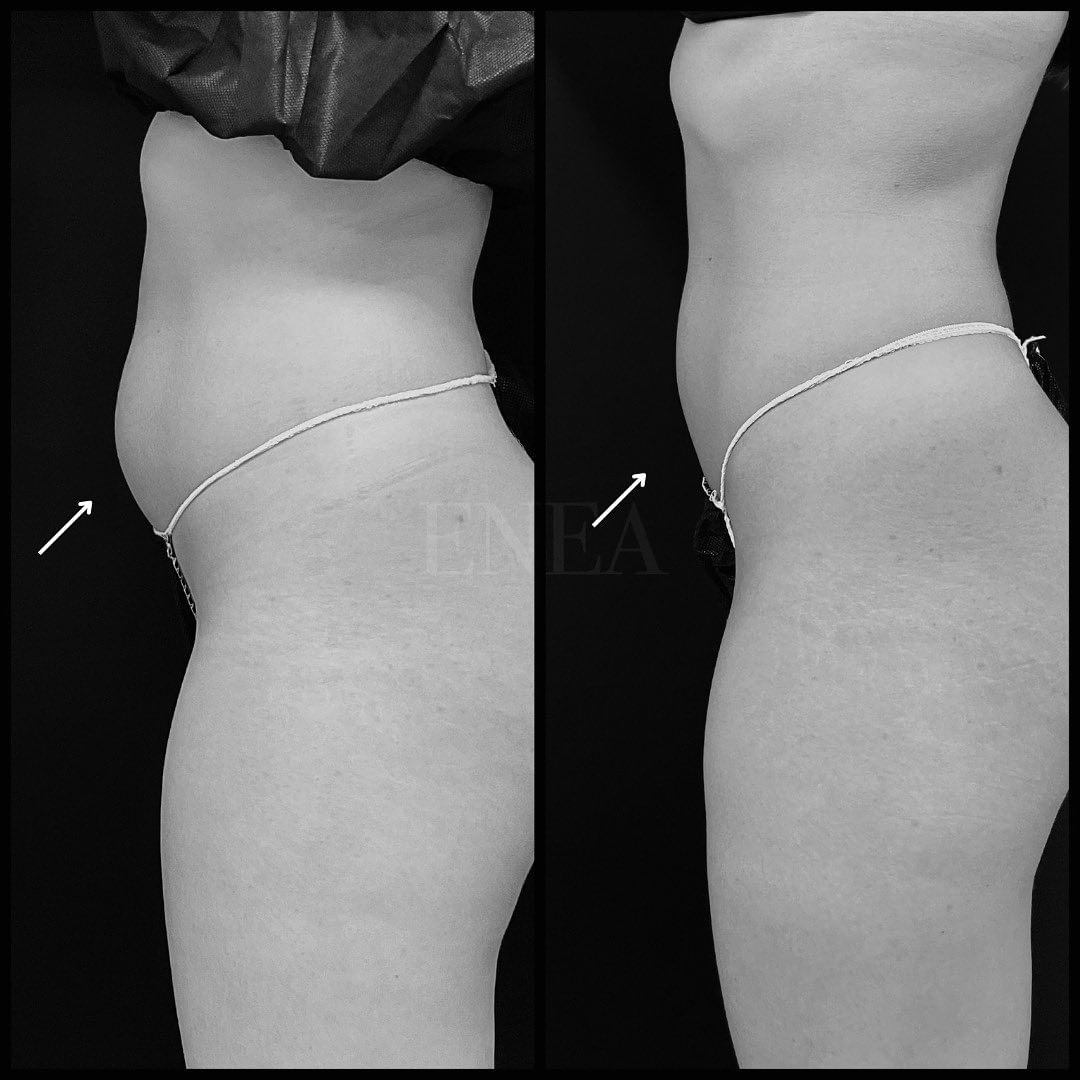 Liposucción sin cirugía, CoolSculpting