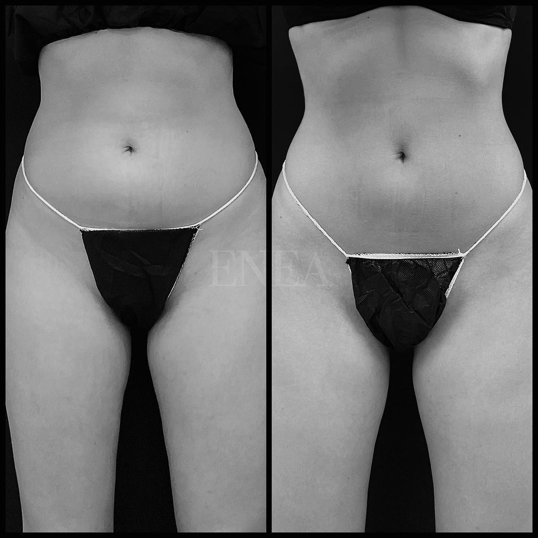 Liposucción sin cirugía, CoolSculpting