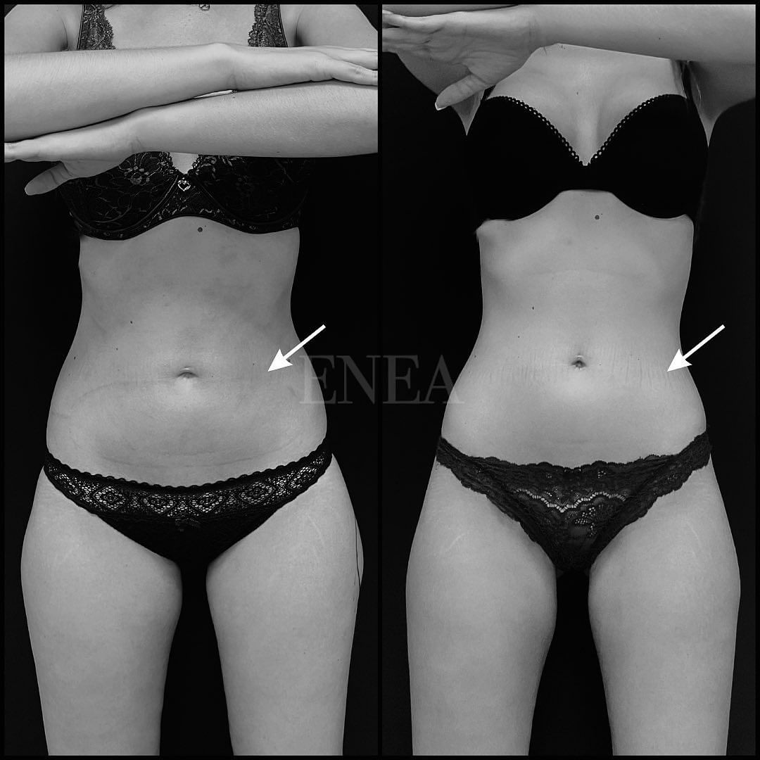 Liposucción sin cirugía, CoolSculpting