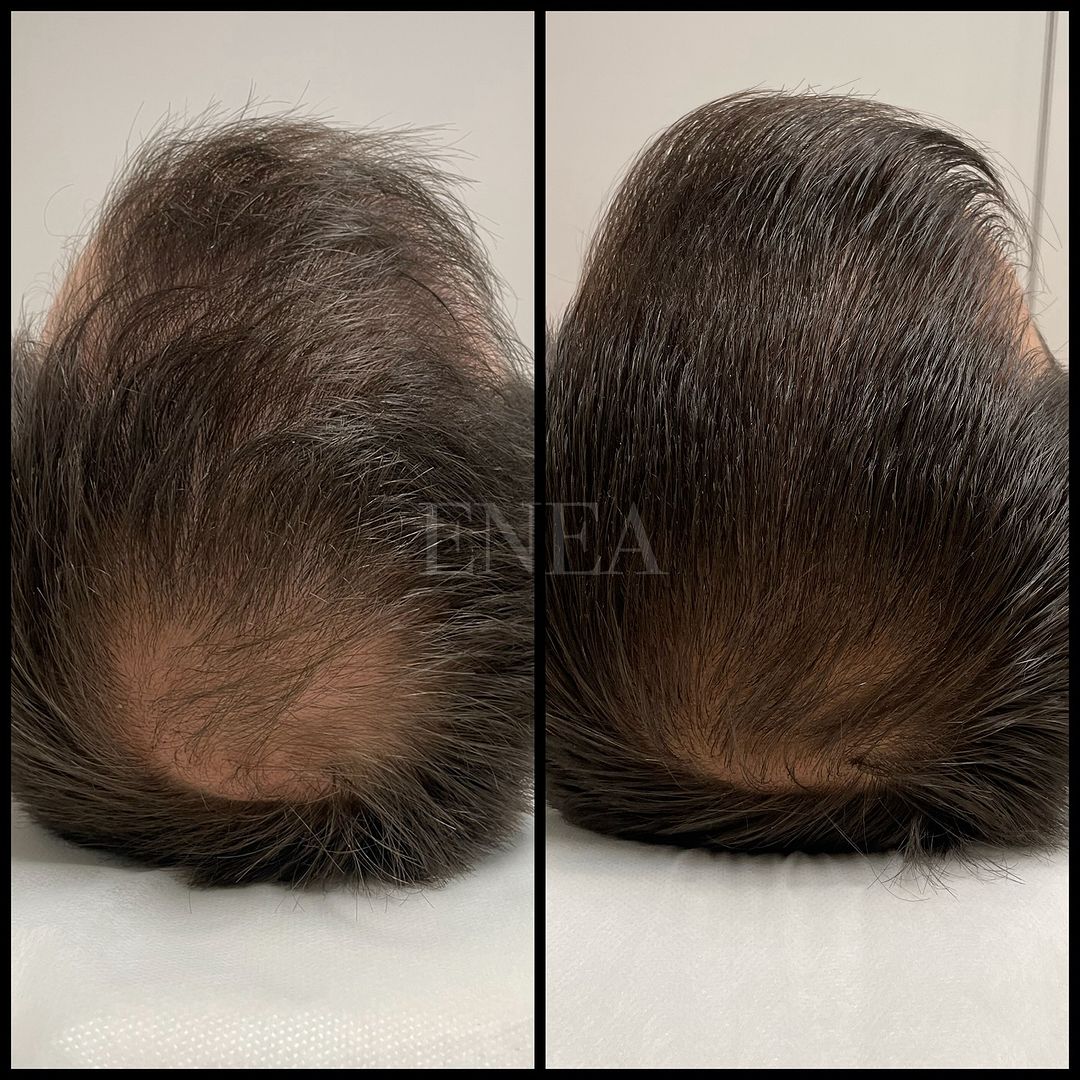 Alopecia androgenética masculina