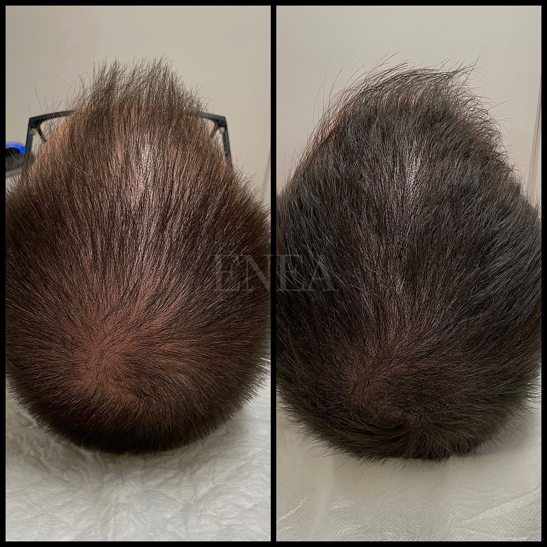 Alopecia androgenética masculina