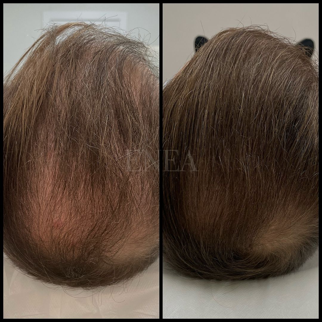 Alopecia androgenética masculina