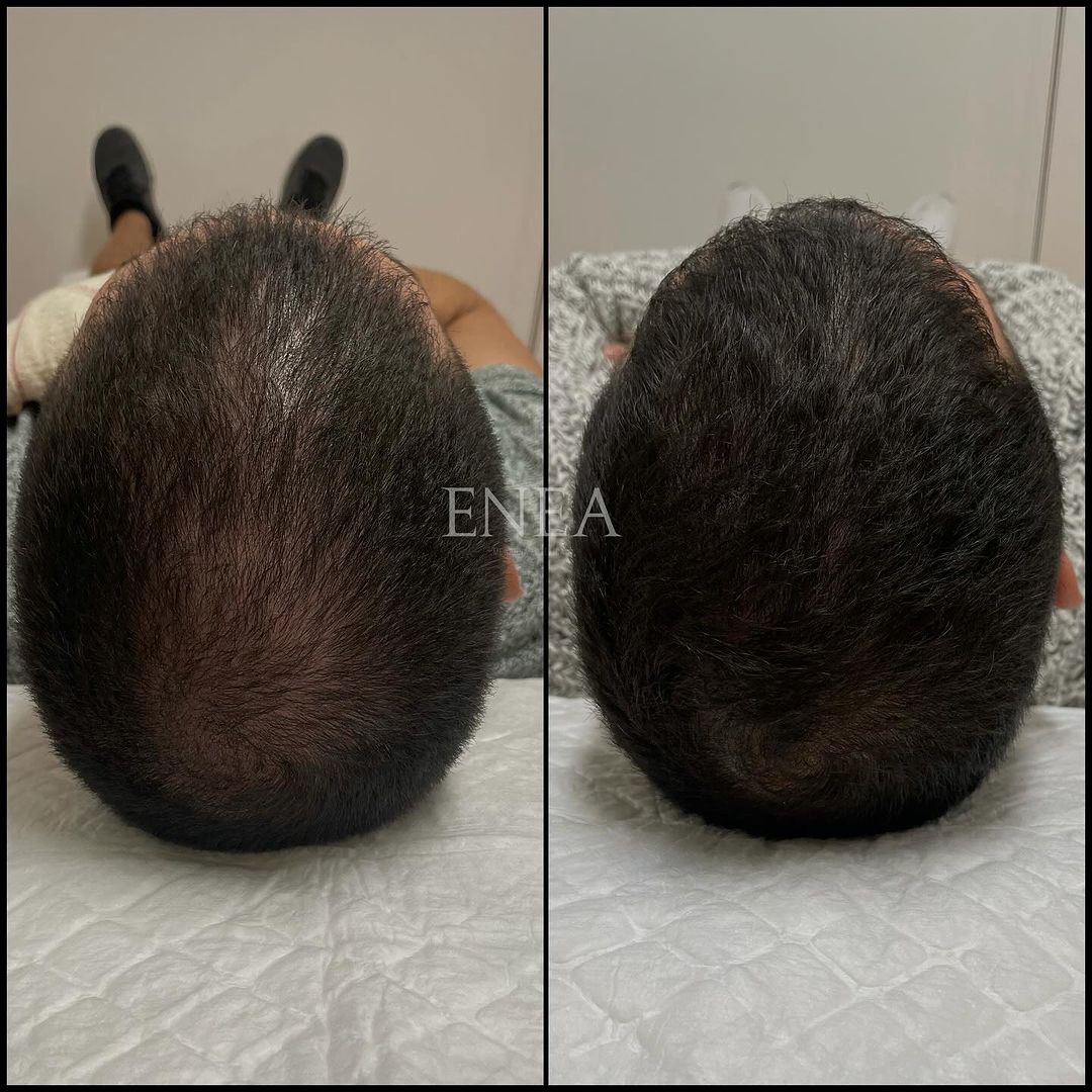 Alopecia androgenética masculina