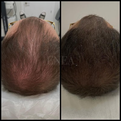 Alopecia androgenética masculina