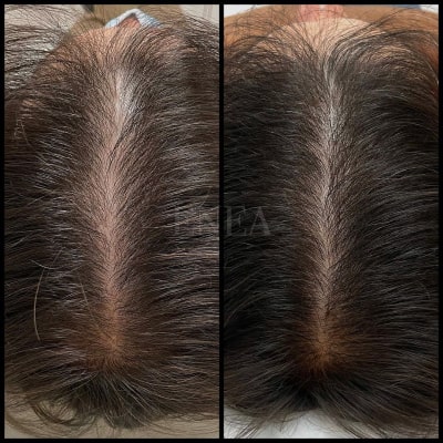 Alopecia androgenética masculina