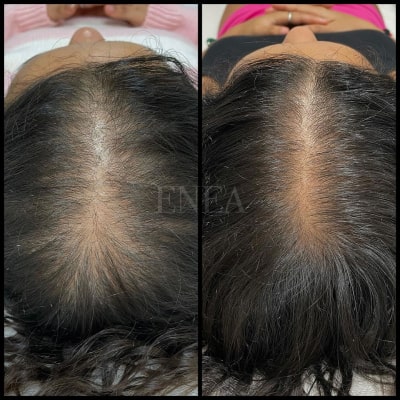 Alopecia androgenética femenina