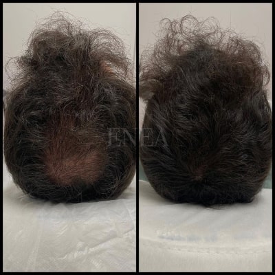 Alopecia androgenética masculina