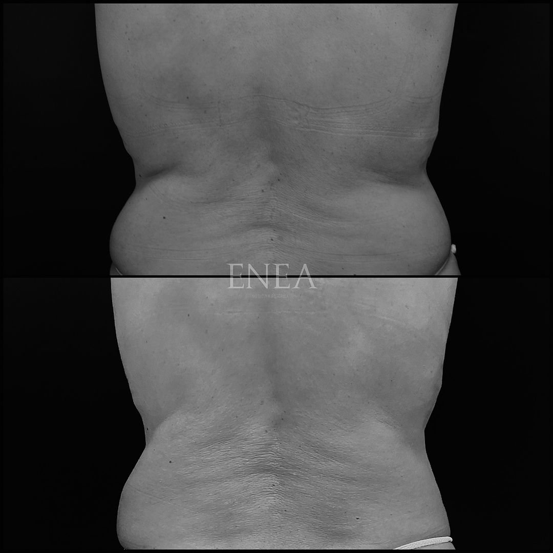 Liposucción sin cirugía, CoolSculpting