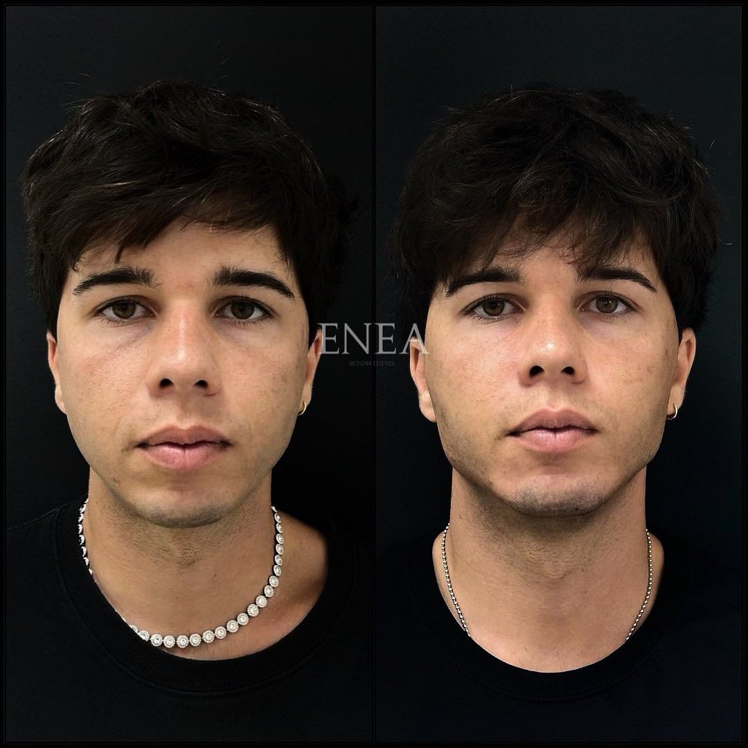 Tratamiento full face, buscando masculinización facial