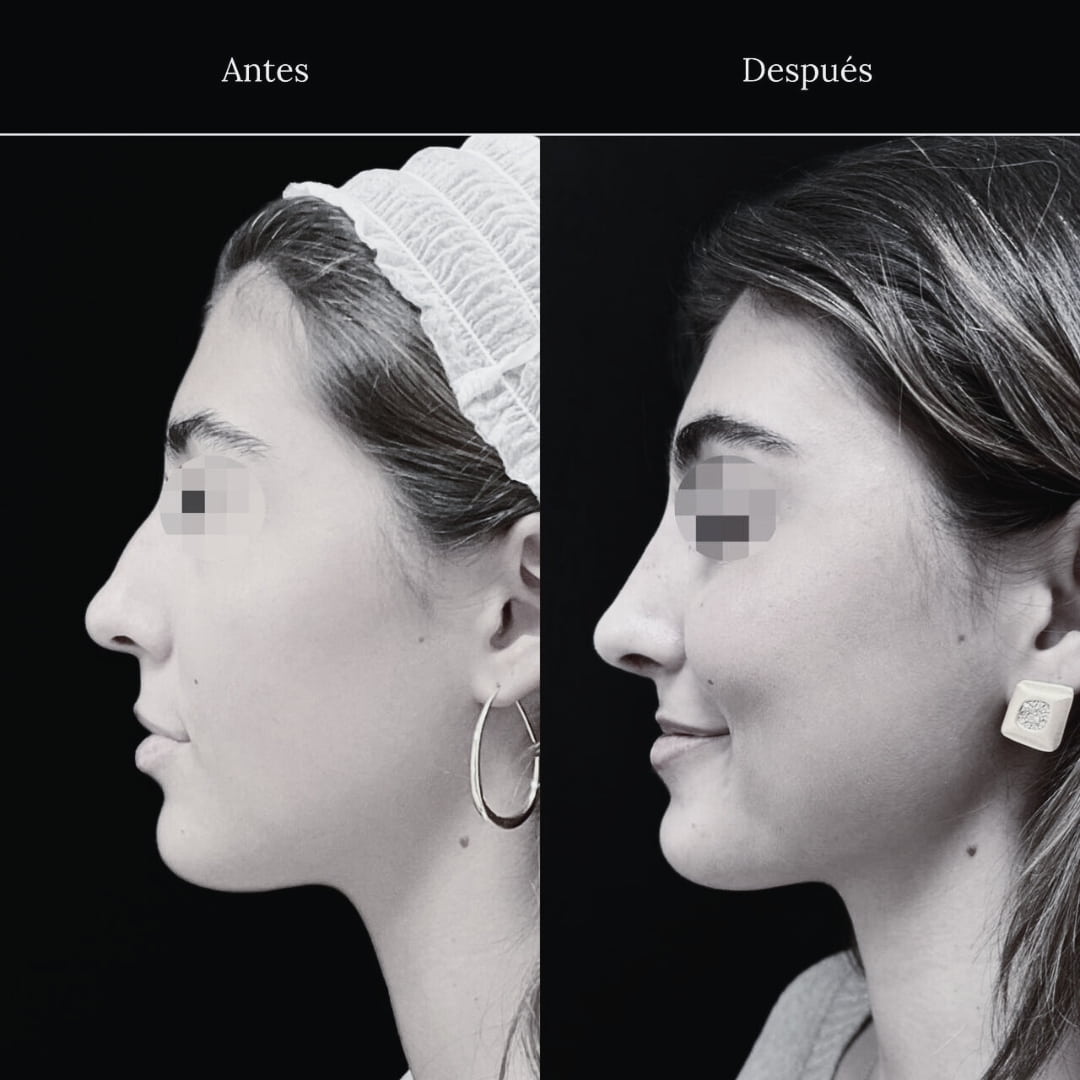 rinoplastia caso Enea