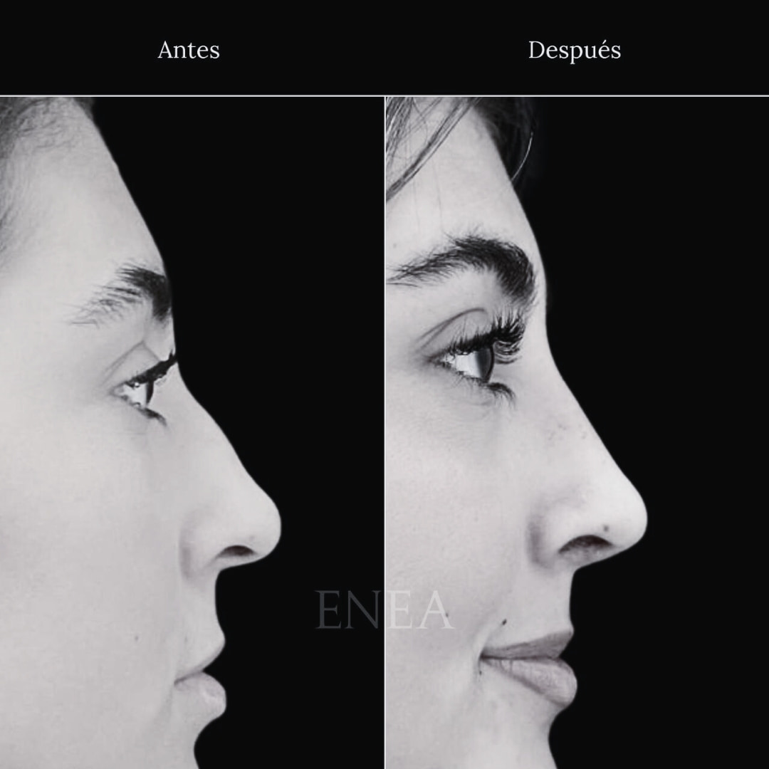 rinoplastia caso Enea