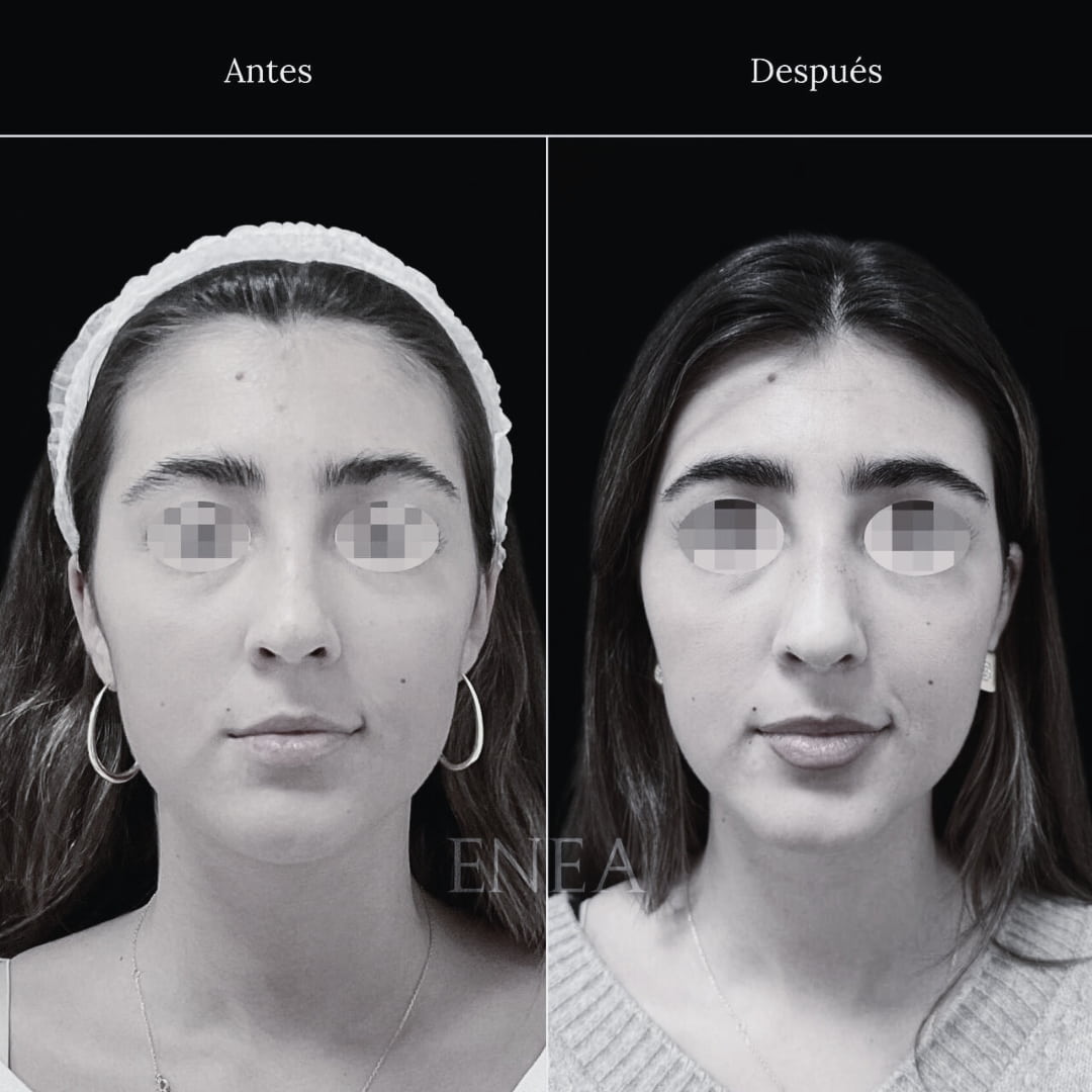 rinoplastia caso Enea