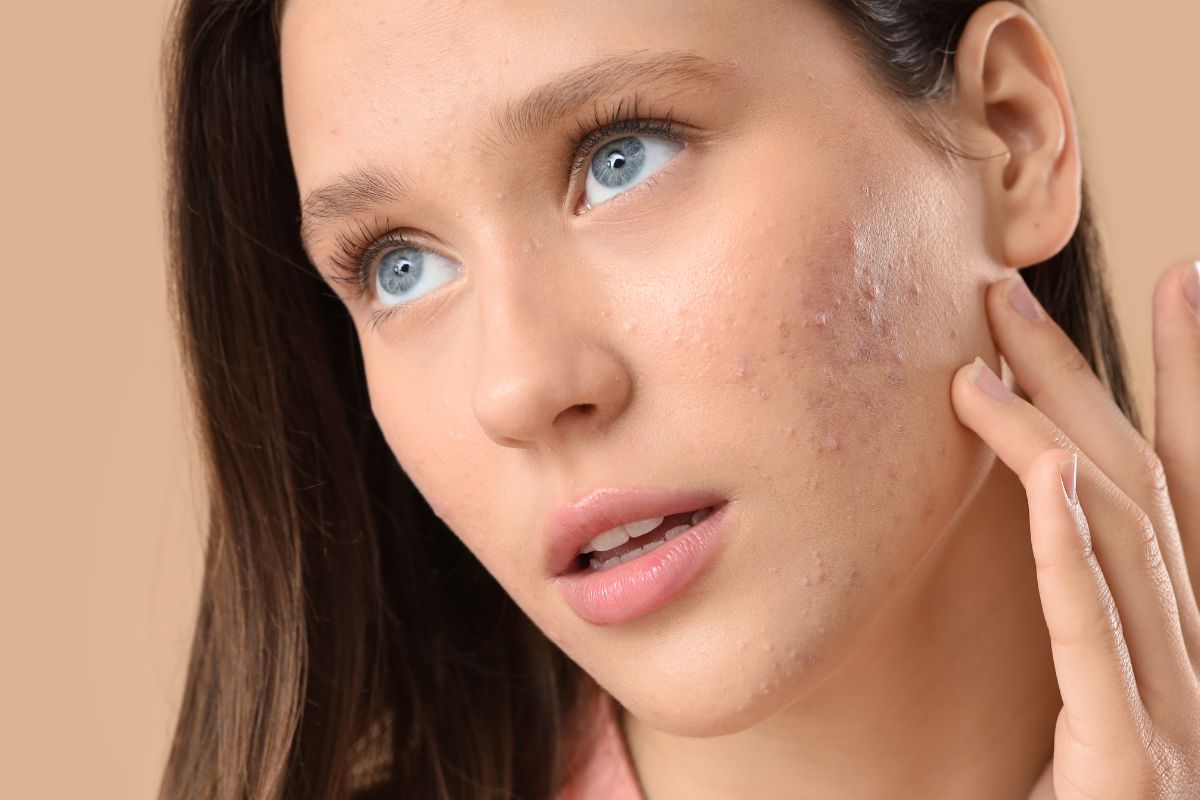 Acné en adultos