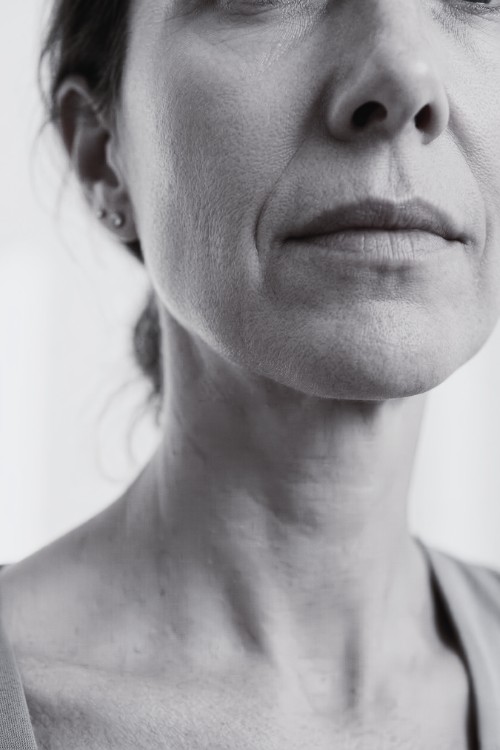 Caso de surco nasogeniano