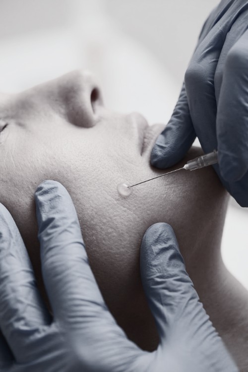 aplicación de mesoterapia facial