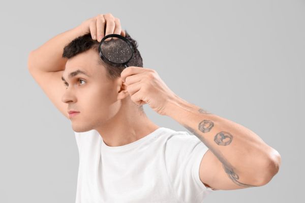 Dermatitis seborreica o caspa