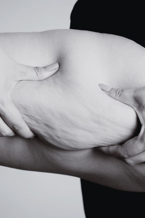 Tratamiento contra la flacidez corporal