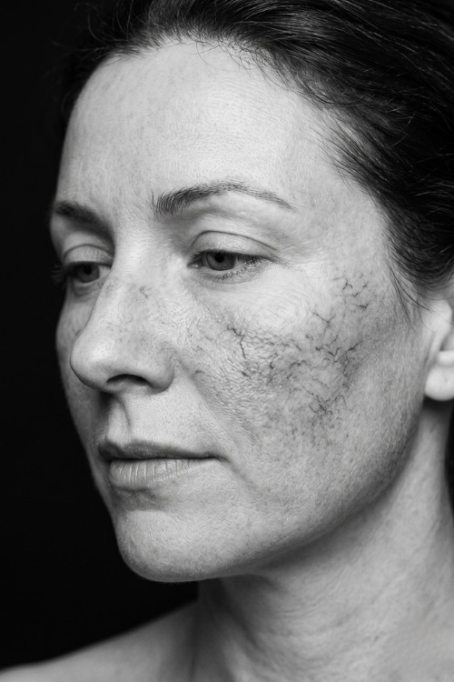 Cómo tratar la rosácea