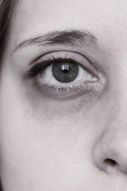 Tratamiento con láser para las ojeras